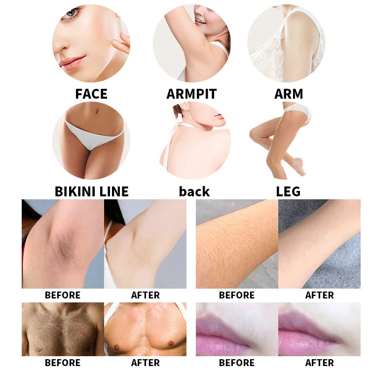 Emszero Soprano Diode Laser Hair Removal Machine 808nm