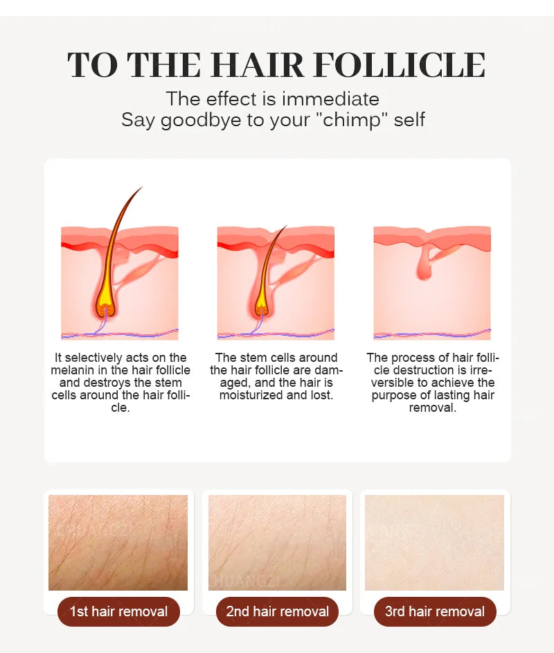 Emszero Soprano Diode Laser Hair Removal Machine 808nm