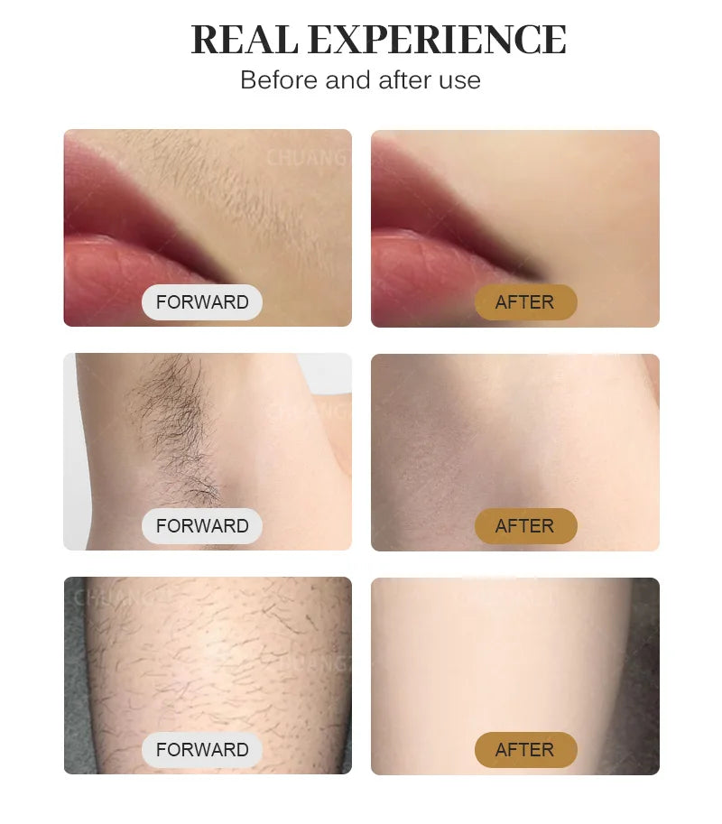 Emszero Soprano Diode Laser Hair Removal Machine 808nm